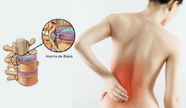 راهکارهای پیشگیری از دیسک کمر
